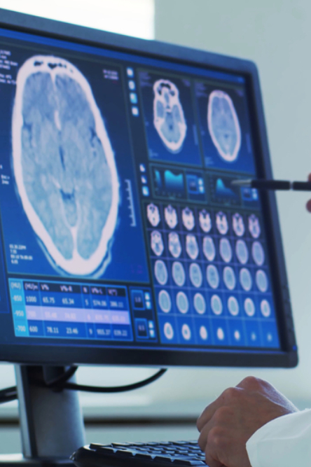 Multiple sclerosis, NMO, MOG